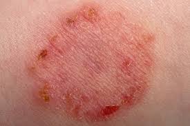 A host of less common culprits other conditions that occasionally look like ringworm include seborrhea , psoriasis , pityriasis , contact dermatitis (such as poison oak ), drug reactions, tinea versicolor, vitiligo, erythema migrans (a rash seen in lyme disease ), and even lupus. Ringworm Look Alike Not Itchy
