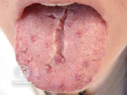Image result for Fissured tongue