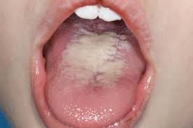 Image result for brown tongue symptoms