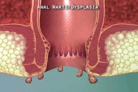 An ingrown hair is a hair that was knocked off course while trying to grow out from under the surface of the skin, says melanie coba, brand ambassador for european wax center. What Are Anal Warts