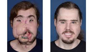 A california man who underwent grueling face transplant surgery earlier this year revealed his new self to the world on thursday. Face Transplant Gives Man New Lease On Life People The Jakarta Post