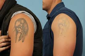 Little Rock Laser Tattoo Removal Before And After Gallery