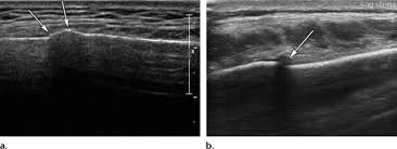 Image result for Sternal Fracture
