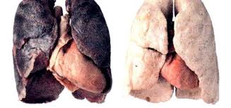 Resultado de imagen para cancer de pulmon fotos
