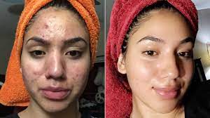 Teen Shares How She Cleared Her Severe Acne Using Cheap Products Gma