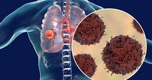 Symptoms of lung cancer develop as the condition progresses and there are usually no signs or symptoms in the early stages. Lung Cancer The Facts Get Healthy Stay Healthy