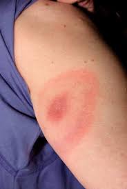 Si toutes lestiques ne transmettent pas la maladie, le risque. Maladie De Lyme Infections Manuels Msd Pour Le Grand Public