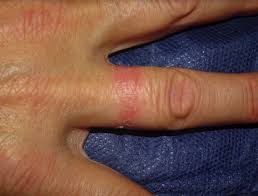 Image result for dermatitis contacta allergica