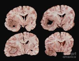 Image result for Brain Abscess