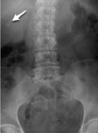 Maybe you would like to learn more about one of these? A 55 Year Old Female With Right Upper Quadrant Pain A A Supine Download Scientific Diagram