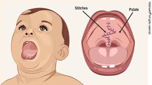 Image result for Cleft Lip