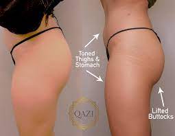 The sculptra buttocks cost will depend on several factors, such as how many treatments you need. Does Sculptra For Cellulite Really Work Qazi Cosmetic Clinic