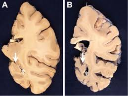 Black diamond, wa 98010 phone: View Of Neuropathology Of The Alzheimer S Continuum An Update Free Neuropathology