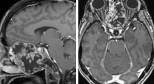 Image result for Chondrosarcoma