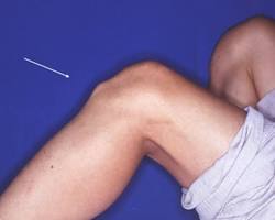 オスグッドの症状の画像