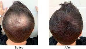 Hair loss concealer side effects. 6096134751158 Caboki Hair Loss Concealer Black 75 Day Supply