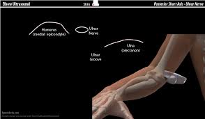 Medial condyle fractures are intraarticular, extending into the elbow joint and require urgent open reduction internal fixation (orif). Elbow Ultrasound