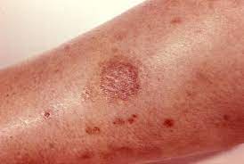 Additionally, it mitigates redness and inflammation. 7 Home Remedies To Treat Spider Bites Organic Pest Control Nyc