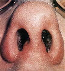 A cream, such as mupirocin, can also be used 2 to 3 times a day the doctor may need to make a small cut and drain out the pus/infection. Rhinitis Acute Runny Nose Anesthesia Key