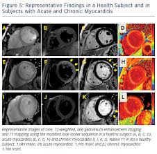 Manage these post covid cardiovascular. Advances In Cardiovascular Mri Using Quantitative Tissue Characterisation Techniques Focus On Myocarditis Ecr Journal