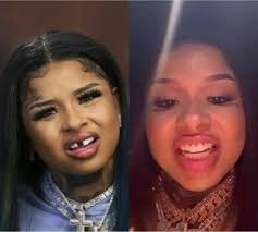 Chrisean Rock got her missing tooth fixed last night 🌙😏