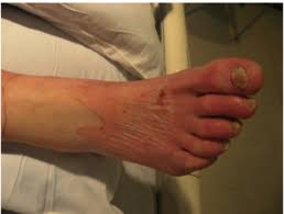 Eschar is composed of necrotic granulation tissue, muscle, fat, tendon or skin. Cellulitis Physiopedia