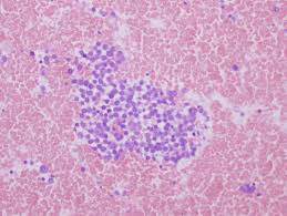 Treatments are often highly individualized, depending on a patient's general health, as well as the tumor's location, size, depth, and degree of spread. Pathology Outlines Case Of The Week 414