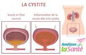 Check spelling or type a new query. La Miction Douloureuse Les Causes Et Les Symptomes Ameliore Ta Sante