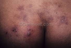 Herpes simplex sutton dermatology aesthetics ctr. Herpes In Buttocks Pictures Photos