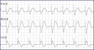 Image result for Transcutaneous Pacing