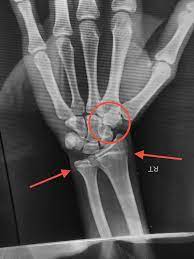Which Body Parts Should I Take An X-Ray To Know If My Growth Plates Have  Merged Or Will I Be More Tall? - Quora