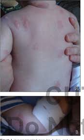 Image result for Urticaria pigmentosa children