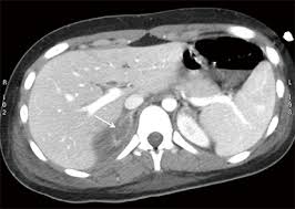 Although several imaging investigations can be applied, ct has a pivotal role in both detection and characterisation of adrenal lesions. Multi Detector Computed Tomography In The Diagnosis And Characterization Of Adrenal Gland Traumatic Injuries Abstract Europe Pmc
