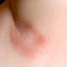 أمراض الجلد الفطرية بالصور ويب طب