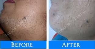 laser hair removal treatment in lucknow