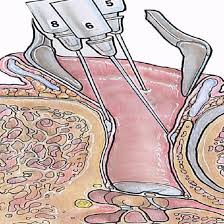 Image result for Ear Nerve Block