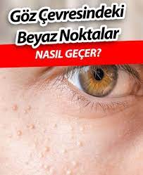 Goz Cevresindeki Beyaz Noktalar Nasil Gecer