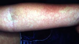 Check spelling or type a new query. Maculopapular Rash Causes Treatment And More