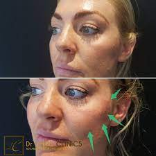 Thread lift before and after eyes. Things To Do Before And After A Pdo Thread Lift
