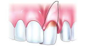 Image result for Tooth Luxation