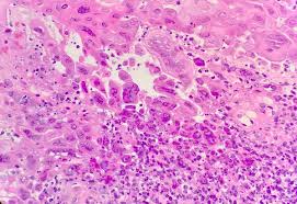 Esophagitis caused by cmv infection, most commonly occurring in patients with cytomegalovirus esophagitis developing during chemoradiotherapy for esophageal cancer. Pathology Outlines Herpes Simplex Esophagitis