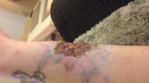 October 1, 2010october 18, 2012. Woman Left With Horrific Burns From A Diy Tattoo Removal Kit