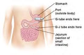 Image result for Enterostomy