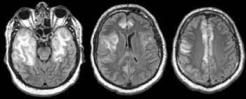 Lesions similar to cytotoxic edema, and lesions similar to vasogenic edema. Herpes Encephalitis3