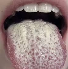 Image result for Oral thrush roof of mouth