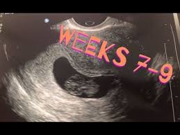 7 9 Weeks Pregnant Spotting Youtube