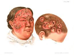Image result for Syphilis