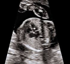Smfm Consult Isolated Echogenic Intracardiac Focus Contemporary Ob Gyn Ultrasound and congenital heart defects. isolated echogenic intracardiac focus