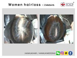 Thus, it may help fight oxidative stress, which can prevent hair loss. Oily Scalp And Hair Loss