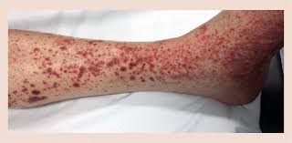 Clinically, leukocytoclastic vasculitis most often presents with palpable purpura, especially on the lower extremities. Palpable Purpuric Rashes On The Anteromedial Aspect Of The Leg Ankle Download Scientific Diagram